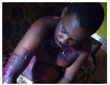 Nigerian man slapped his wife during an argument and she retaliated by pouring hot water on him while he was asleep (Photos) 1