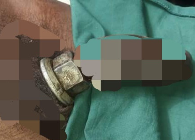 Nigerian Man gets operated on after a metal nut got stuck in his private part while masturbating (Photos) 5