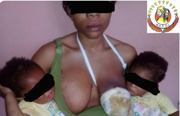 21-year-old nursing mother's breast begins to decay after she was allgedly bitten by her uncle 9 21-year-old nursing mother's breast begins to decay after she was allgedly bitten by her uncle 9
