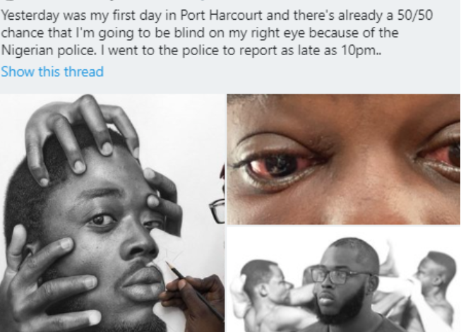 Nigerian artist accuses PH police of brutality, says he might go blind on his right eye 1 Nigerian artist accuses PH police of brutality, says he might go blind on his right eye 1